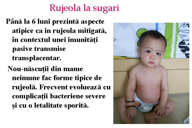 Rujeola la sugari Până la 6 luni prezintă aspecte atipice ca in rujeola mitigată,