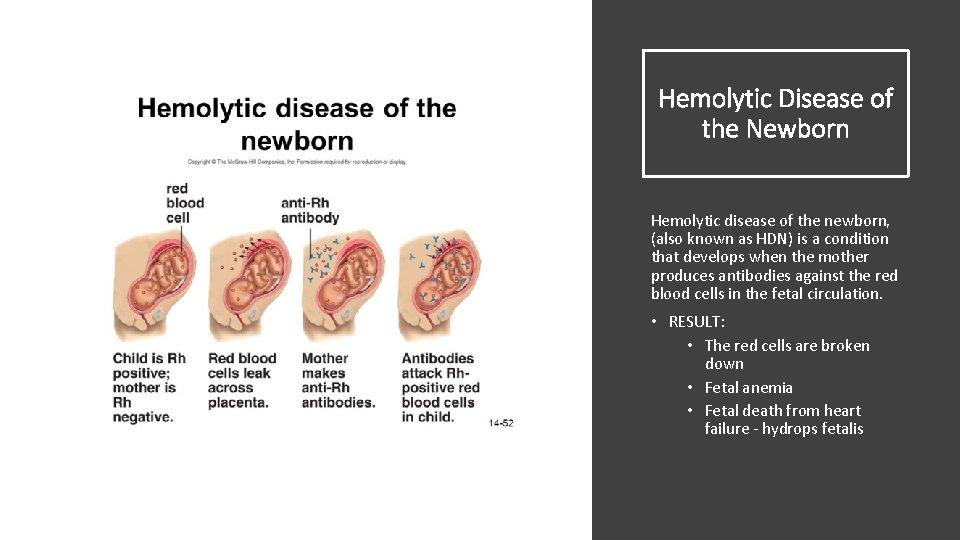 Hemolytic Disease of the Newborn Hemolytic disease of the newborn, (also known as HDN)