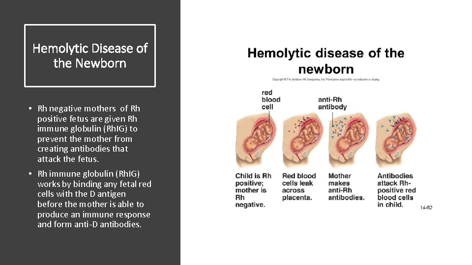 Hemolytic Disease of the Newborn • Rh negative mothers of Rh positive fetus are