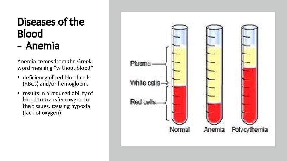 Diseases of the Blood - Anemia comes from the Greek word meaning "without blood“