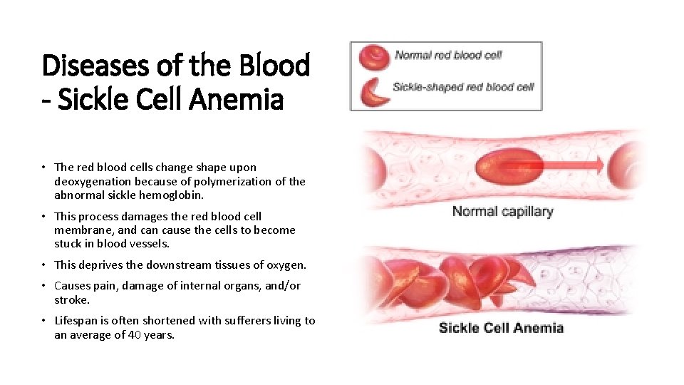 Diseases of the Blood - Sickle Cell Anemia • The red blood cells change