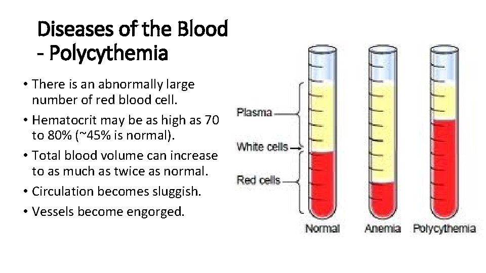 Diseases of the Blood - Polycythemia • There is an abnormally large number of