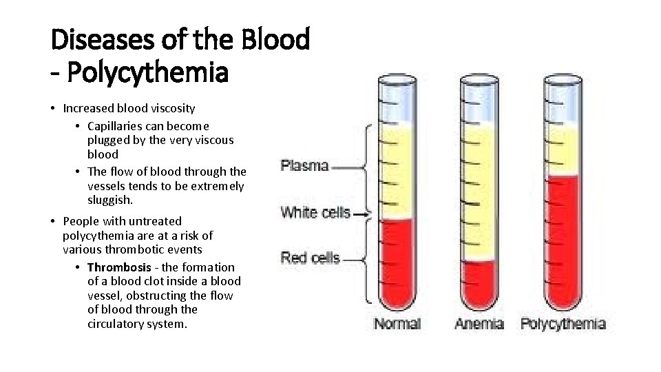 Diseases of the Blood - Polycythemia • Increased blood viscosity • Capillaries can become