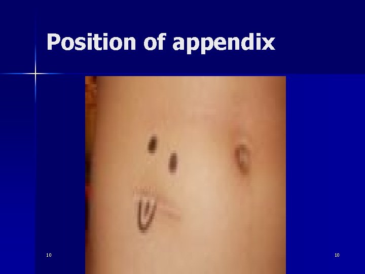 Position of appendix 10 10 