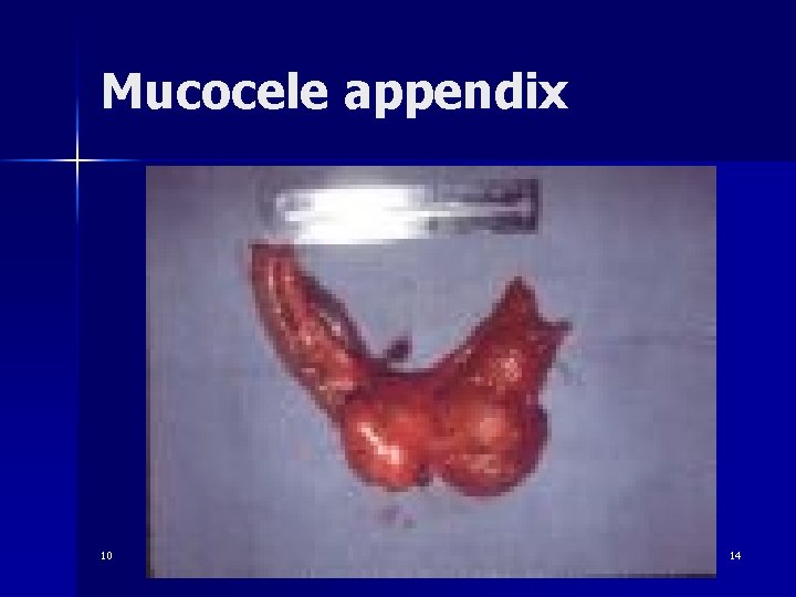 Mucocele appendix 10 14 