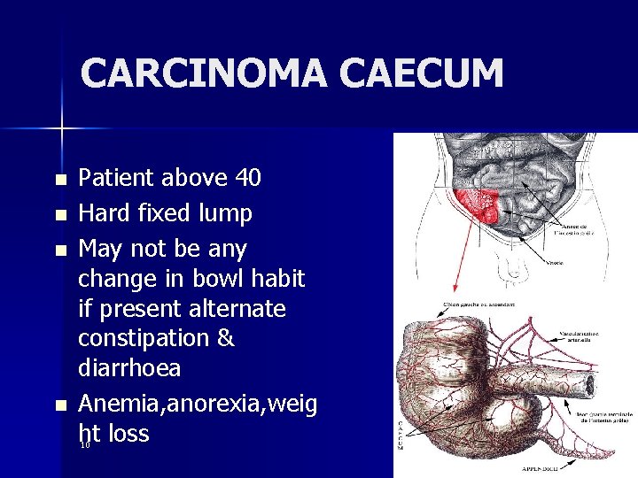 CARCINOMA CAECUM n n Patient above 40 Hard fixed lump May not be any