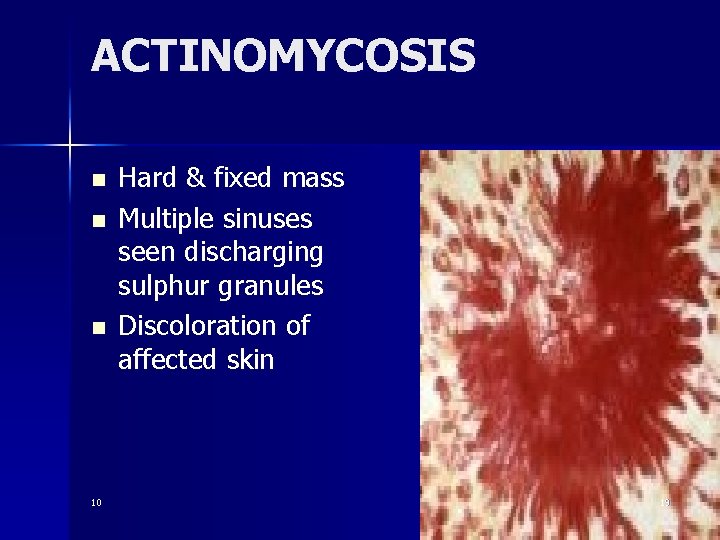 ACTINOMYCOSIS n n n 10 Hard & fixed mass Multiple sinuses seen discharging sulphur