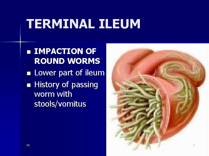 TERMINAL ILEUM n n n 10 IMPACTION OF ROUND WORMS Lower part of ileum