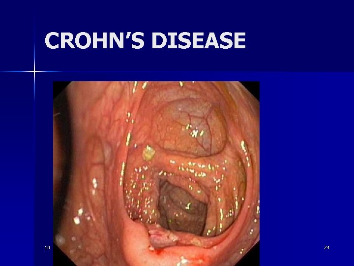 CROHN’S DISEASE 10 24 