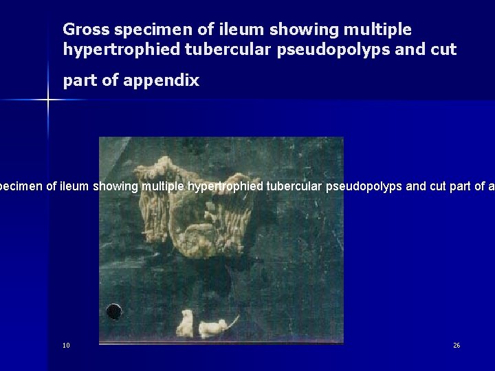 Gross specimen of ileum showing multiple hypertrophied tubercular pseudopolyps and cut part of appendix