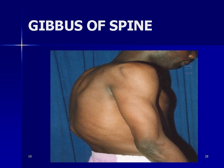 GIBBUS OF SPINE 10 28 