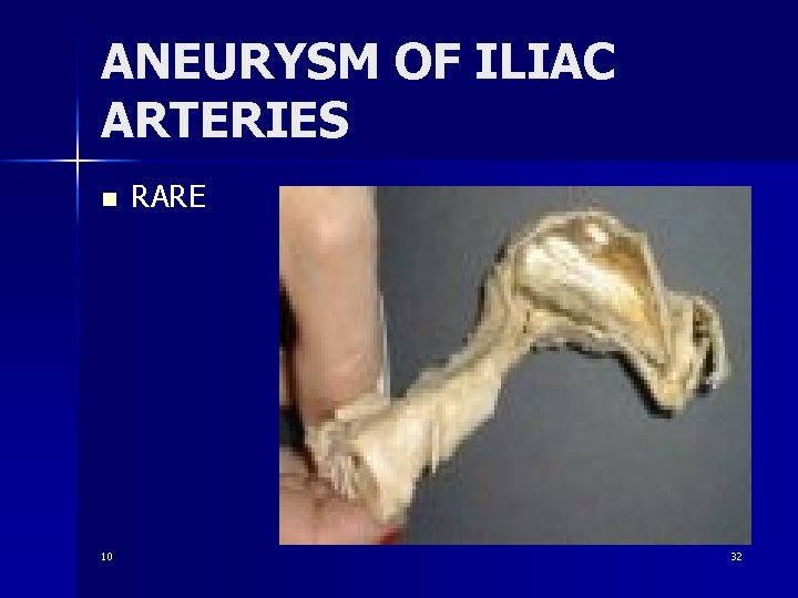 ANEURYSM OF ILIAC ARTERIES n 10 RARE 32 