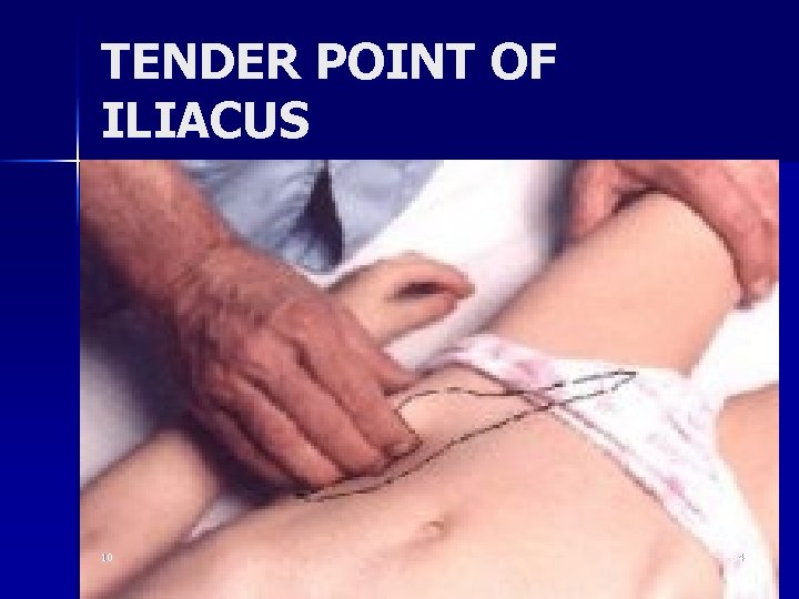 TENDER POINT OF ILIACUS 10 34 