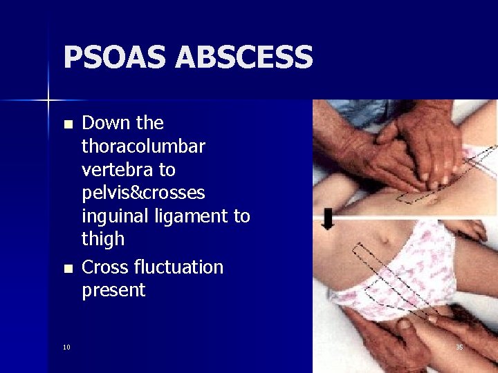 PSOAS ABSCESS n n 10 Down the thoracolumbar vertebra to pelvis&crosses inguinal ligament to