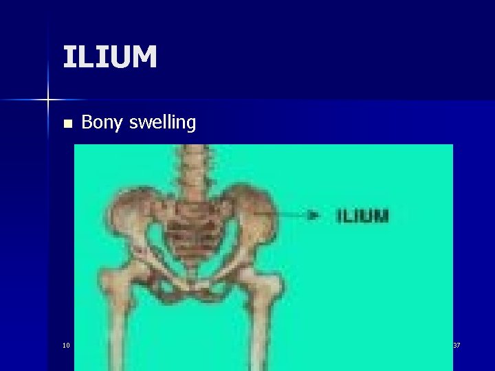 ILIUM n 10 Bony swelling 37 