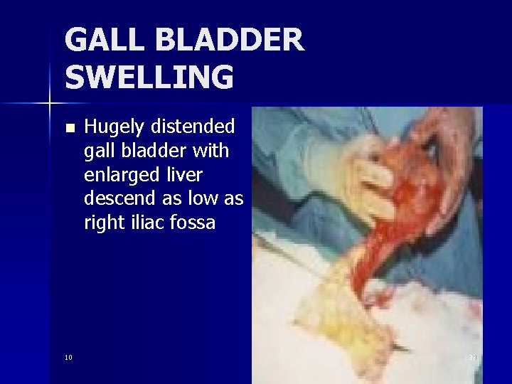 GALL BLADDER SWELLING n 10 Hugely distended gall bladder with enlarged liver descend as