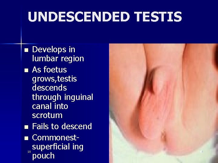 UNDESCENDED TESTIS n n 10 Develops in lumbar region As foetus grows, testis descends