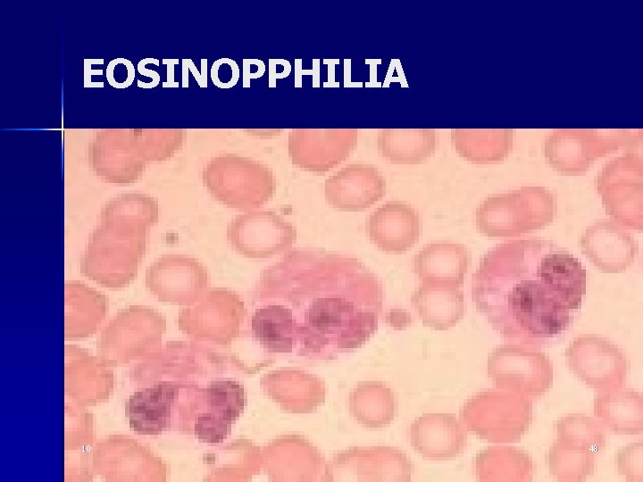 EOSINOPPHILIA 10 48 