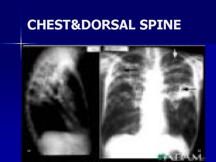 CHEST&DORSAL SPINE 10 52 