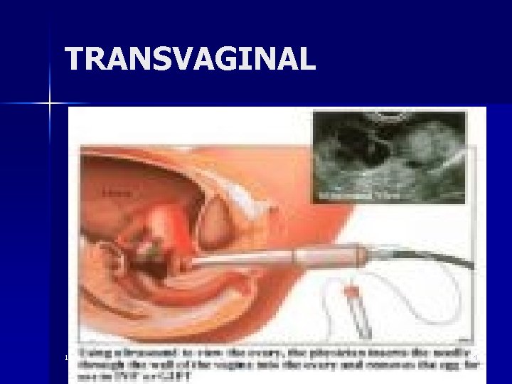 TRANSVAGINAL 10 54 