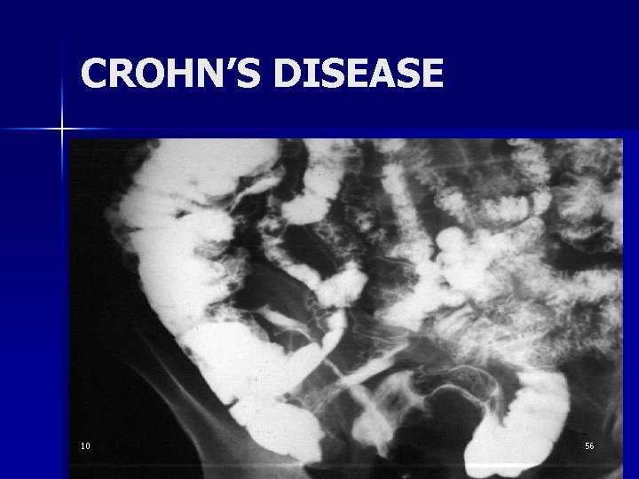 CROHN’S DISEASE 10 56 