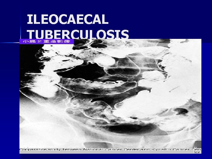 ILEOCAECAL TUBERCULOSIS 10 58 