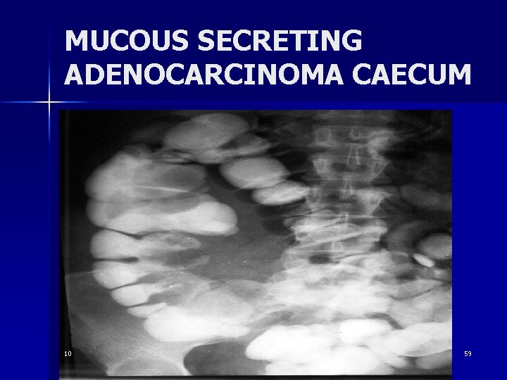 MUCOUS SECRETING ADENOCARCINOMA CAECUM 10 59 