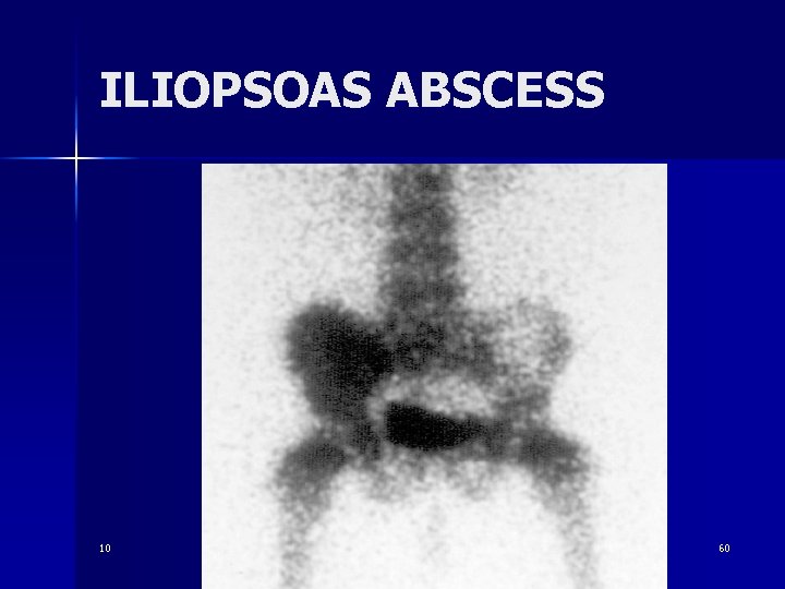 ILIOPSOAS ABSCESS 10 60 