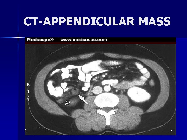 CT-APPENDICULAR MASS 10 62 