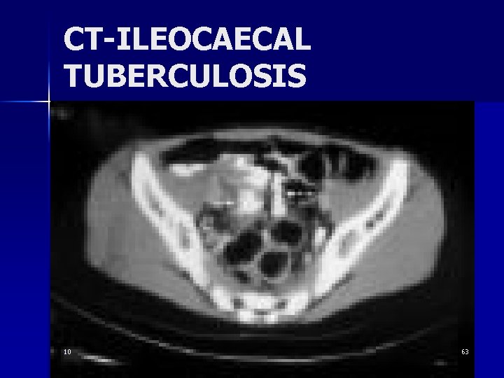 CT-ILEOCAECAL TUBERCULOSIS 10 63 