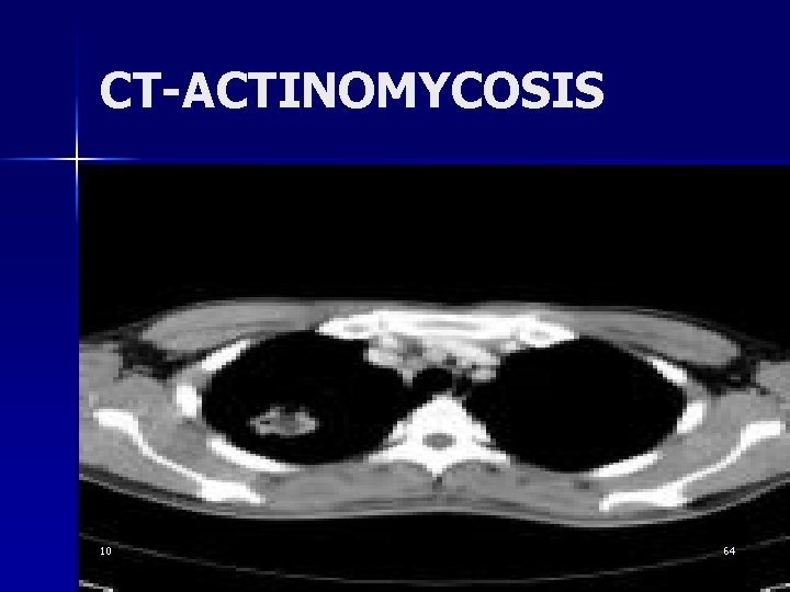 CT-ACTINOMYCOSIS 10 64 