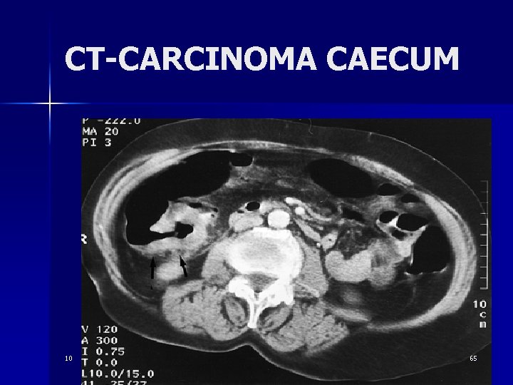 CT-CARCINOMA CAECUM 10 65 