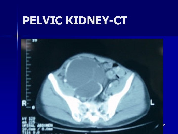 PELVIC KIDNEY-CT 10 66 