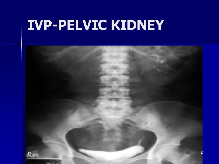 IVP-PELVIC KIDNEY 10 67 