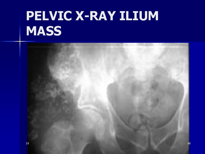 PELVIC X-RAY ILIUM MASS 10 68 