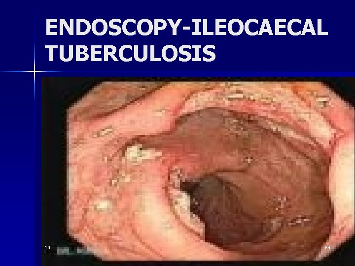 ENDOSCOPY-ILEOCAECAL TUBERCULOSIS 10 69 