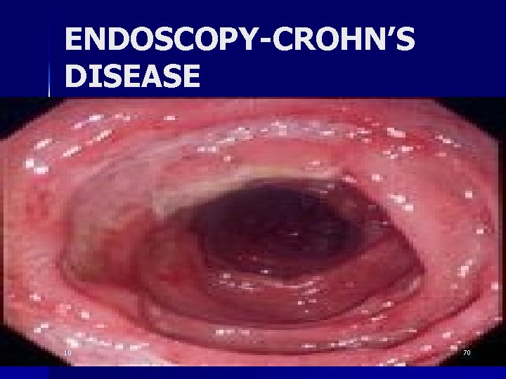 ENDOSCOPY-CROHN’S DISEASE 10 70 