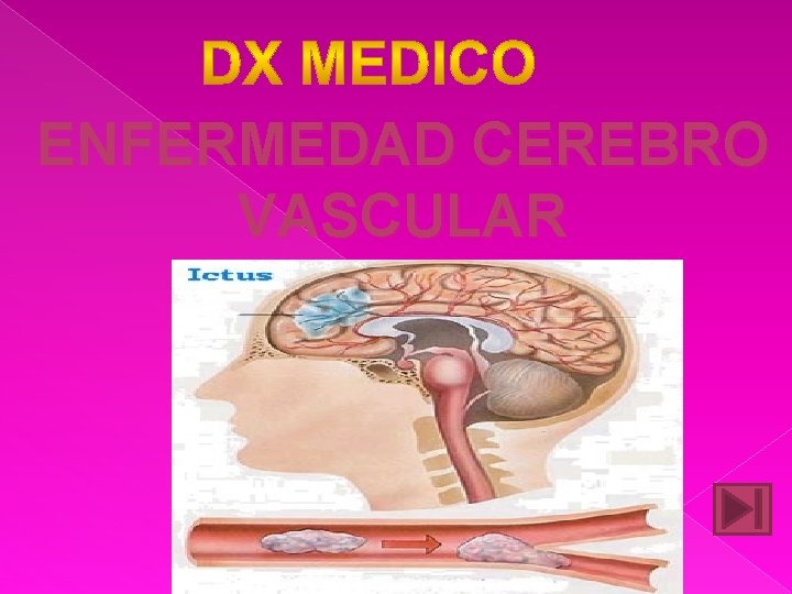 ENFERMEDAD CEREBRO VASCULAR 