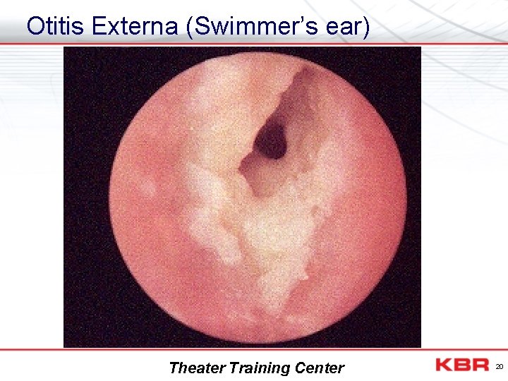 Otitis Externa (Swimmer’s ear) Theater Training Center 20 