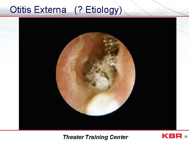 Otitis Externa (? Etiology) Theater Training Center 25 