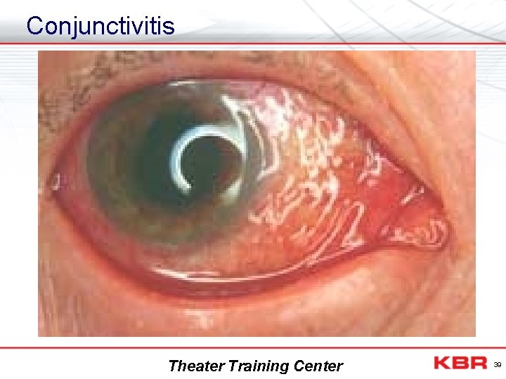 Conjunctivitis Theater Training Center 39 