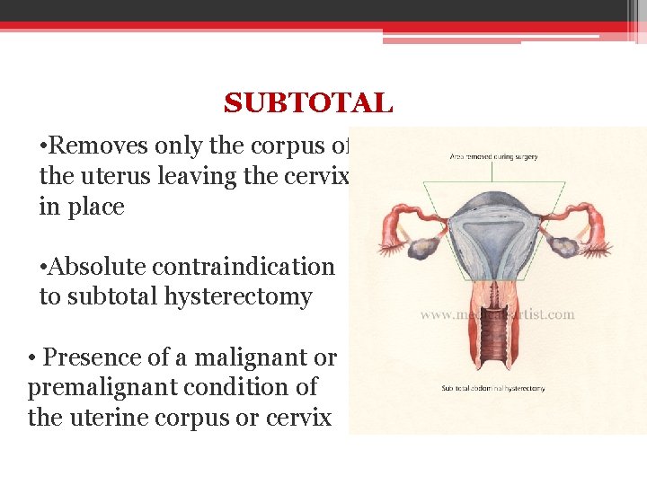 SUBTOTAL • Removes only the corpus of the uterus leaving the cervix in place