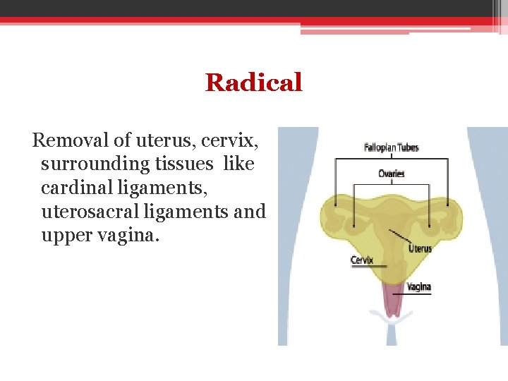 Radical Removal of uterus, cervix, surrounding tissues like cardinal ligaments, uterosacral ligaments and upper