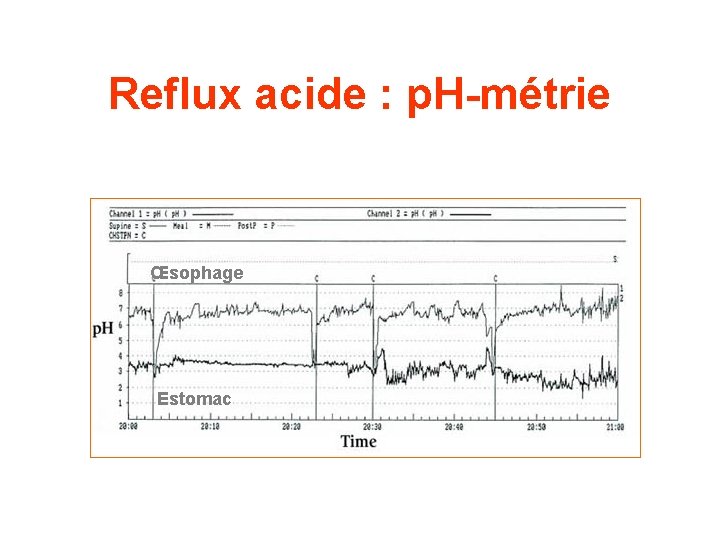 Reflux acide : p. H-métrie Œsophage Estomac 