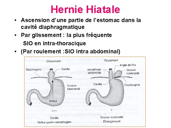 Hernie Hiatale • Ascension d’une partie de l’estomac dans la cavité diaphragmatique • Par