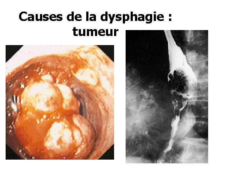 Causes de la dysphagie : tumeur 