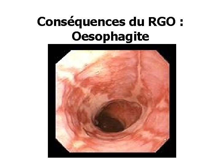 Conséquences du RGO : Oesophagite 