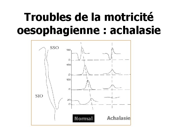 Troubles de la motricité oesophagienne : achalasie Normal Achalasie 