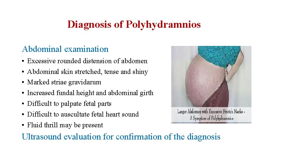 Diagnosis of Polyhydramnios Abdominal examination • • Excessive rounded distension of abdomen Abdominal skin