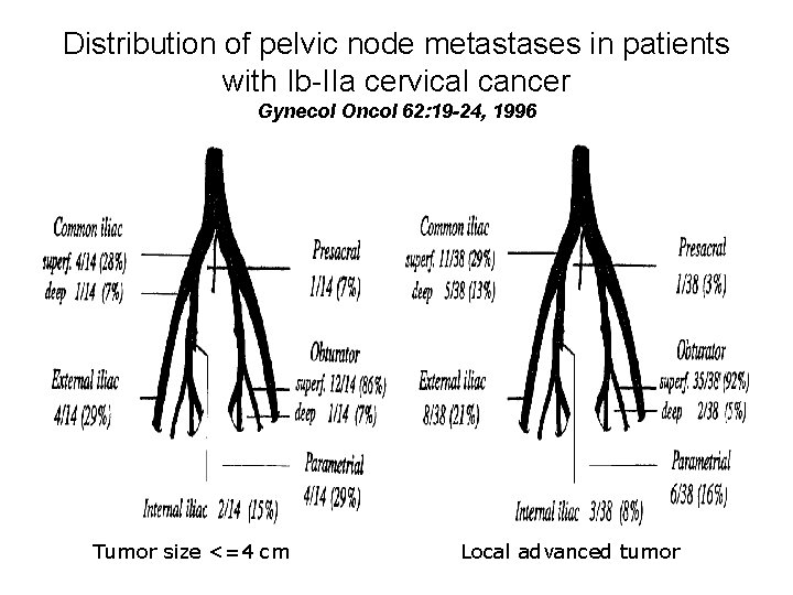 Distribution of pelvic node metastases in patients with Ib-IIa cervical cancer Gynecol Oncol 62: